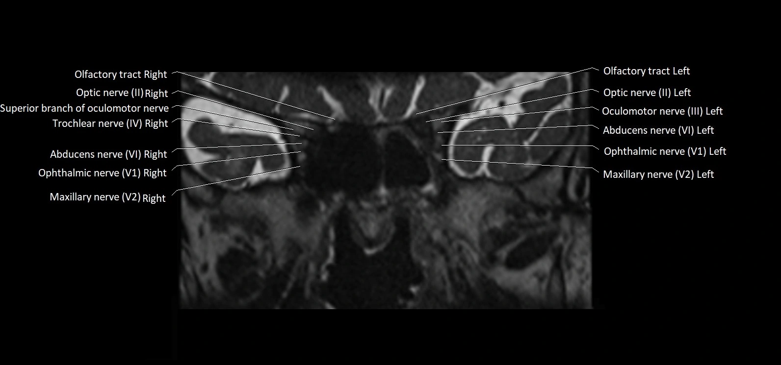 Cranial nerve cross sectional anatomy coronal 3T MRI image 18.webp